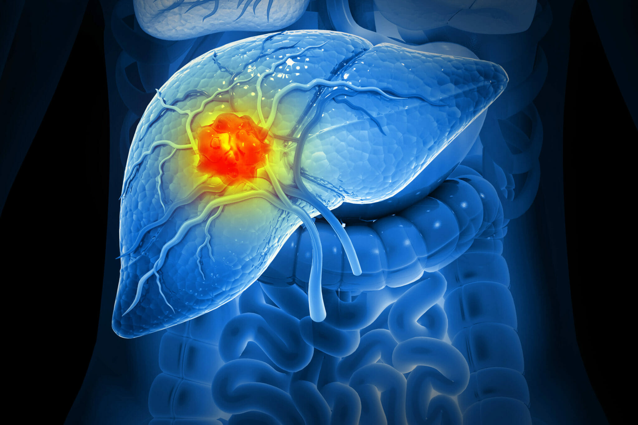 Stomach (Gastric) Cancer: Early Symptoms, Upper GI Endoscopy & Gastrectomy